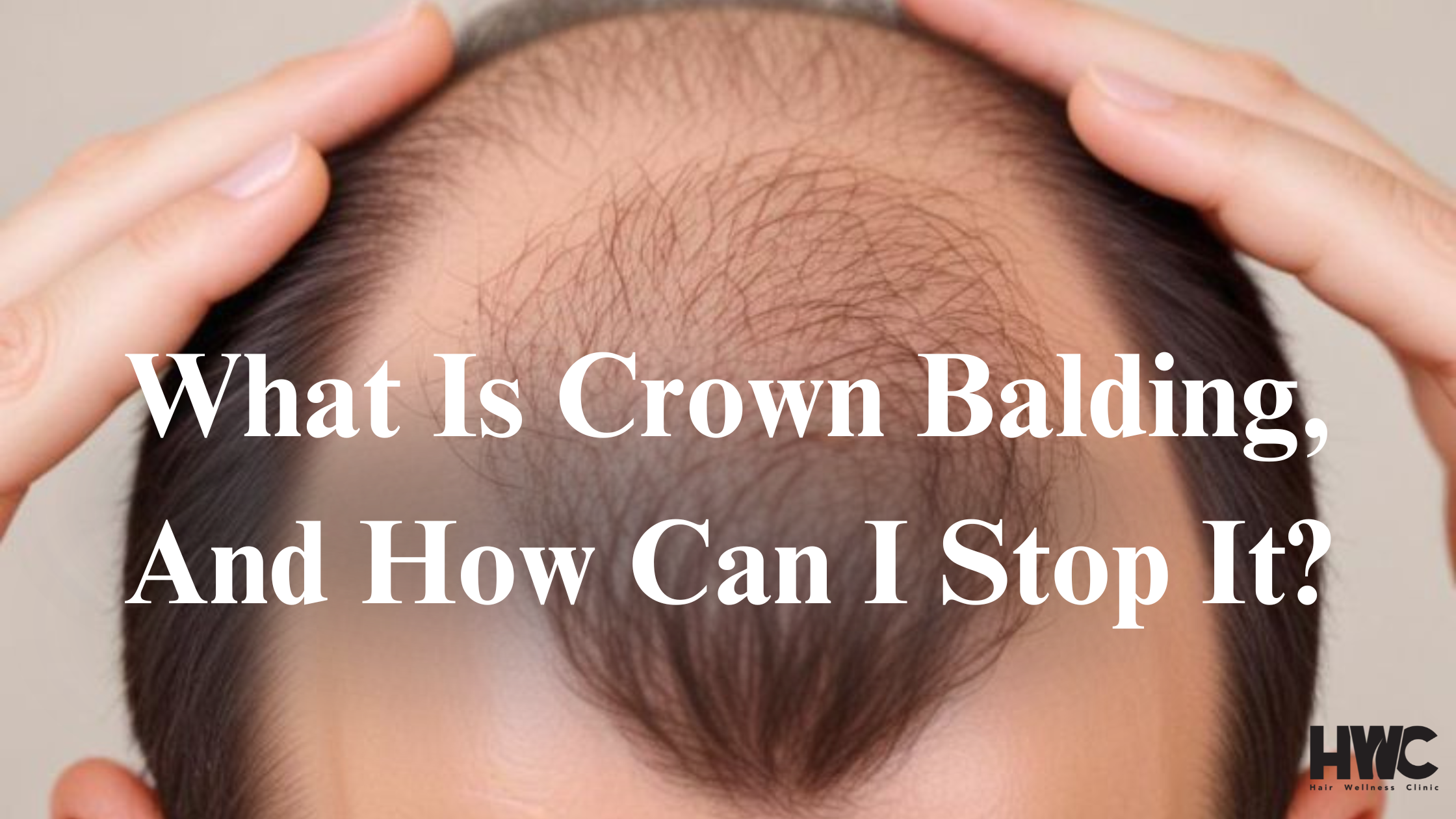 Long hair transplant - Hair transplant without cutting or shaving head in Kerala - HWC